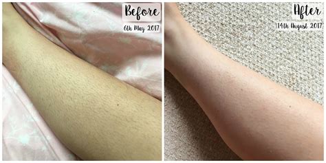 tria 4x before and after|tria laser hair removal before and after.